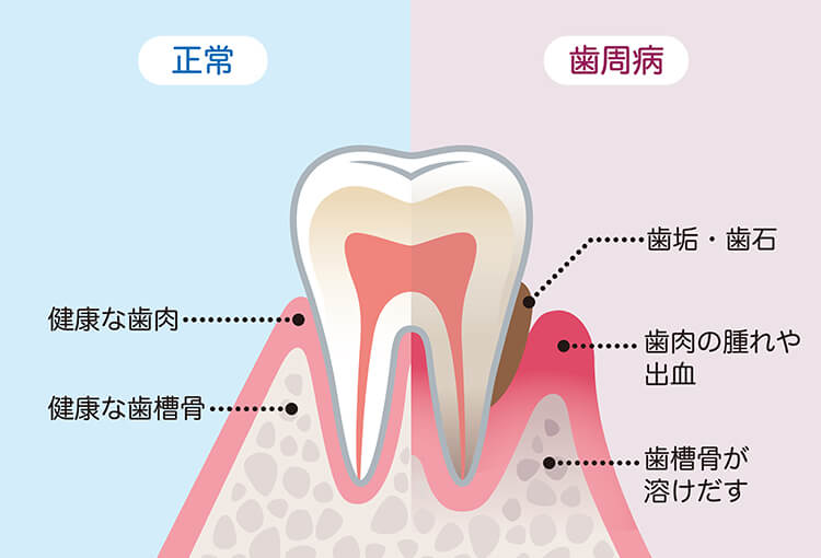 正常な歯と歯周病の歯の違い
